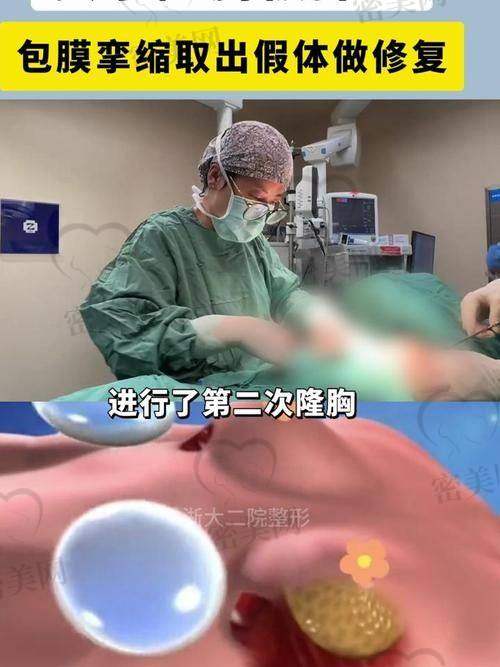 傲诺拉假体相关价格参考