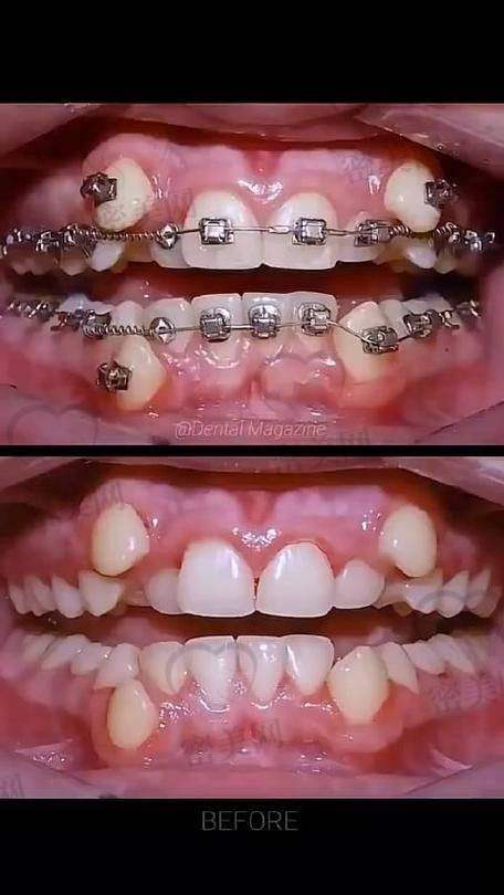 MRC矫正器有副作用吗？佩戴不适怎么办？