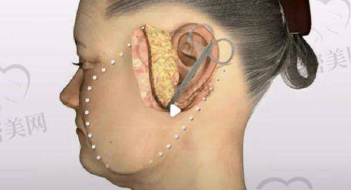 科普一波:不同小拉皮术式和价格参考(附适用人群)