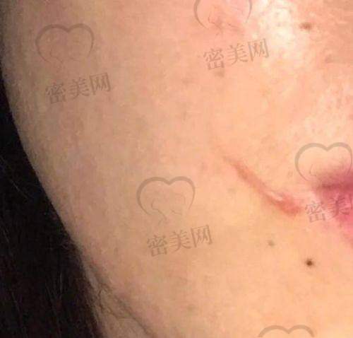 成都美辰星耀医疗：中西结合治疗疤痕