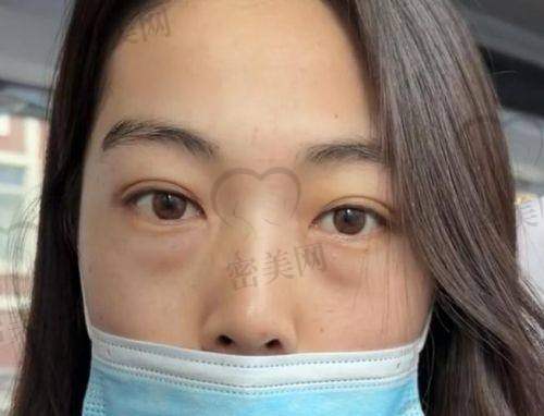 石家庄美联臣高玉伟：1980 元祛眼袋，价格香到离谱！