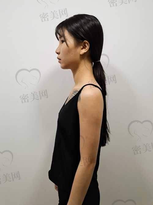 傲诺拉隆胸的适应人群有限制吗？