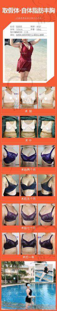 真人实例：15800 元让她变身“胸”器女神