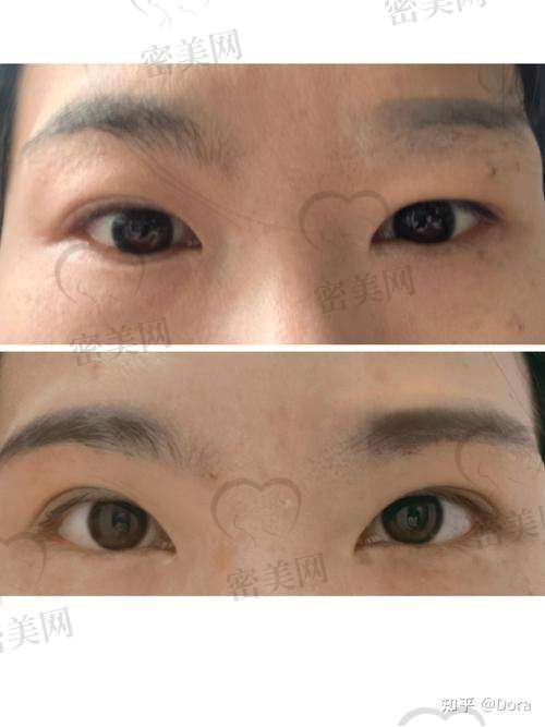 石家庄美联臣整形医院高玉伟提眉：价格香到离谱！