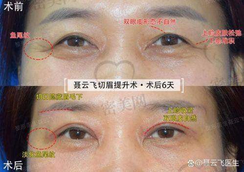 石家庄美联臣整形医院高玉伟提眉：口碑爆棚等你来！