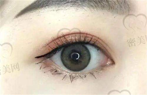 刘志刚医生双眼皮修复价格一览表