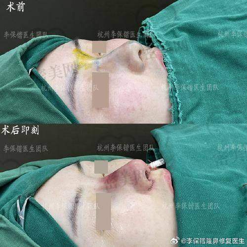 如果打完玻尿酸鼻子肿了，可以自己消肿吗？