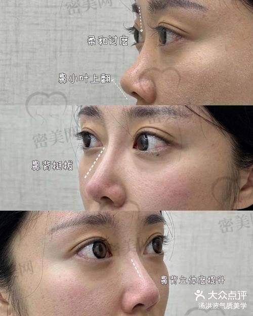 打溶解酶疼吗？有什么副作用？