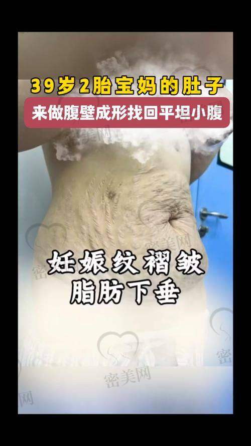 燕京京医生：腹壁整形界的“魔法大师”