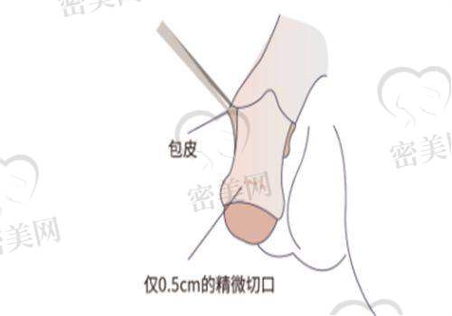 武汉中翰付毅医生：小切口拉皮抗衰术后如“天生紧致”