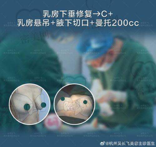 写在后面——假体种类千千万，适合你的只有一款
