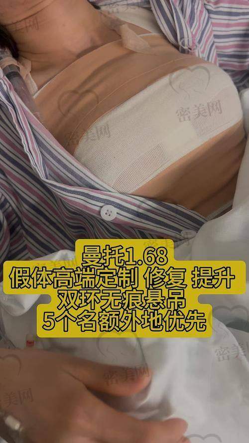 探秘假体傲诺拉璀璨的型号