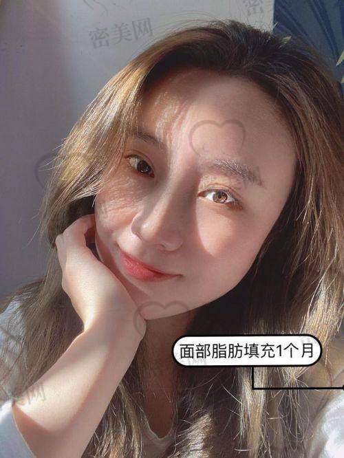 面部脂肪填充：3800 元带来的N大优势
