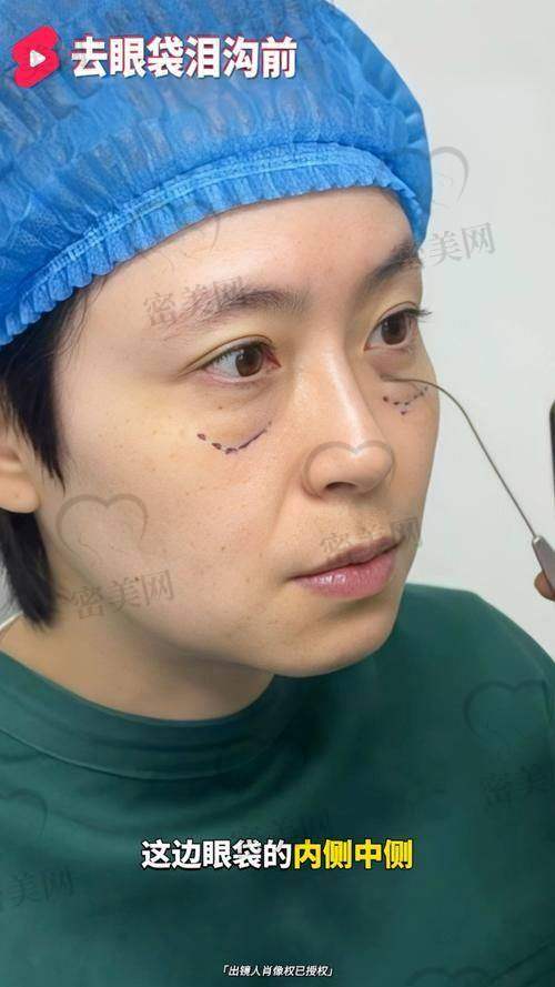 真人实例：燕京京祛眼袋见证奇迹时刻