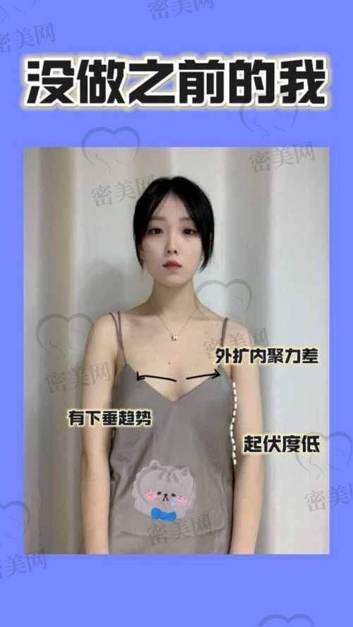 小贴士：广州隆胸方式怎么选？