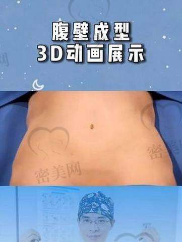 高阶腹壁成形到底适合谁？这些人更需要“8万元套餐”
