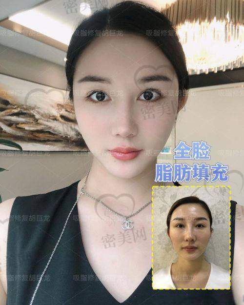 高玉伟医生：面部脂肪填充界的“魔法师”