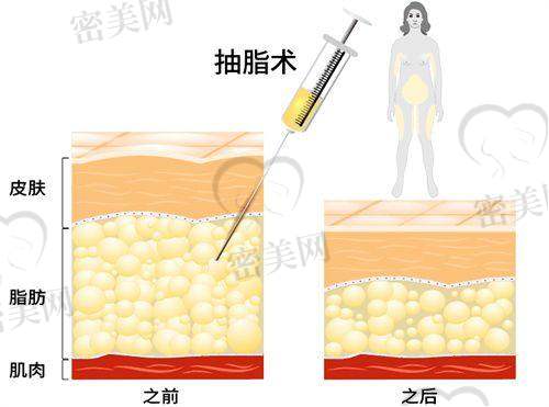 合肥清华梧桐医美：吸脂线条打造出彩