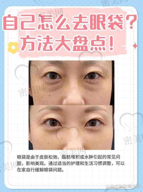 患者亲述眼袋修复真实实例：老眼袋变新美人