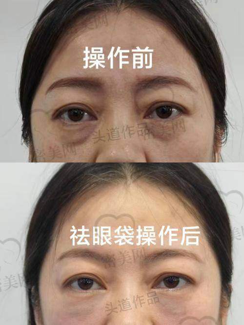 邯郸华景医院张丙海：三分钟去眼袋，价格亲民到尖叫！