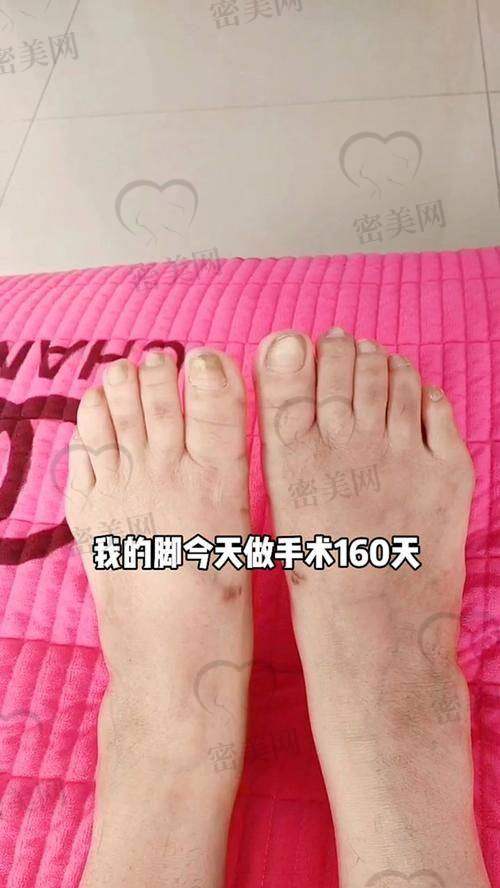 邯郸华景医院张丙海：6800 起的大脚骨矫正“白菜价”