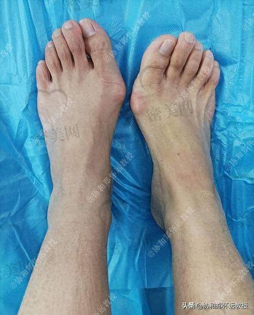 张丙海医生：大脚骨矫正界的“武林高手”