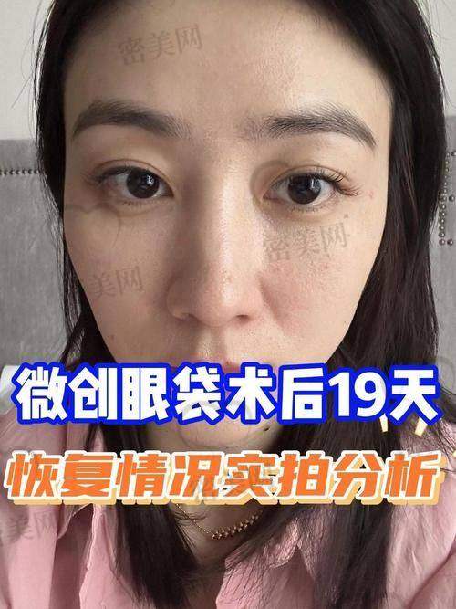 北京八大处眼袋手术项目及价格参考