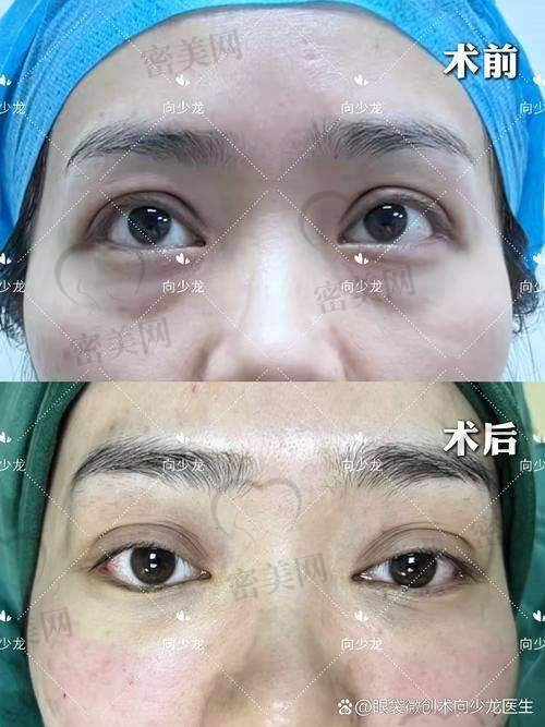 为什么郑州眼袋修复都选黄军伟医生？口碑说明一切