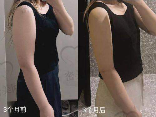 合肥柏荟医疗美容医院：主打精细威塑吸脂