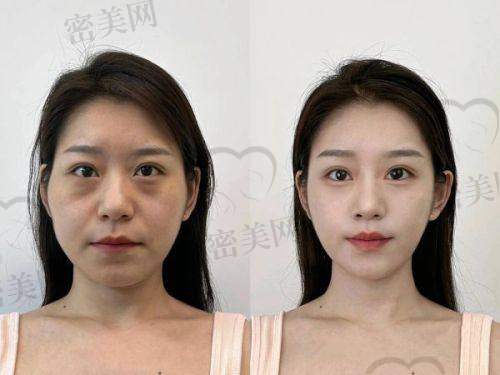 王阔远的微创减容技术：核心器械 + 多步骤，术后见效快又自然