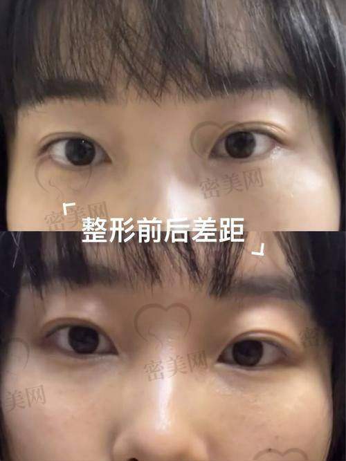 真人实例见证：石家庄美联臣郭东超祛眼袋成效惊人！