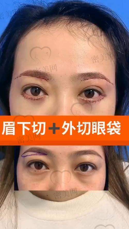 石家庄美联臣整形医院：提眉项目的优质平台