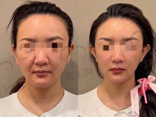 术后管理到位：王阔远医生“闭坑”率高的隐藏功臣