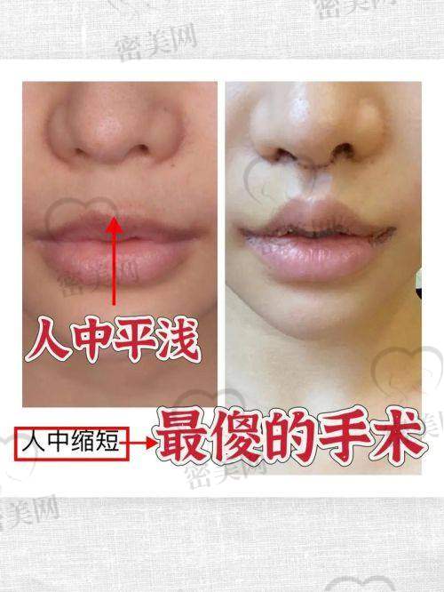 人中三件套术前：紧张又期待