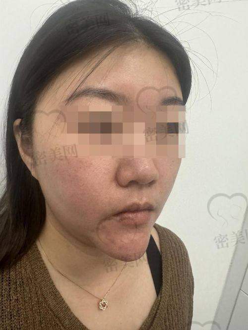 北京美肌源医疗美容诊所:处理高难度异物残留骨干医生