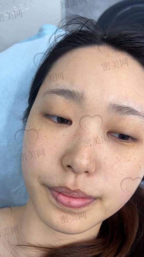 激光祛斑治疗后的费用还要花多少?术后护理是不是另收费?