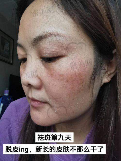 襄阳中 心医院激光祛斑有哪些价格影响因素?