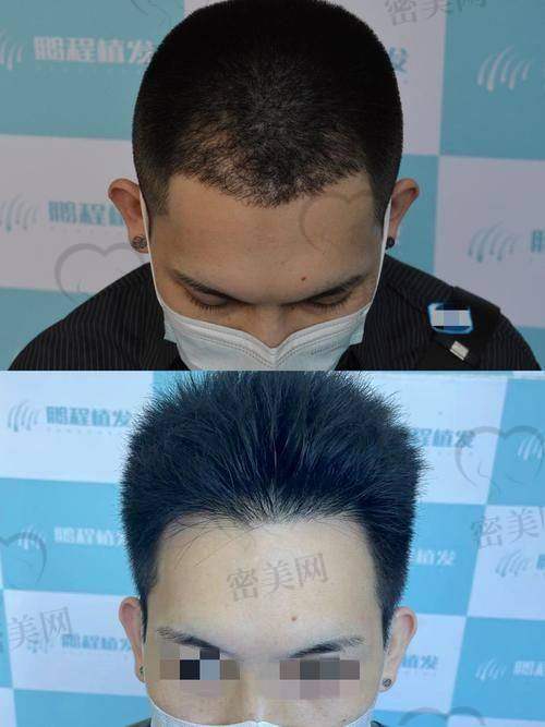 遂宁熙美医疗美容门诊部——陈杰医生