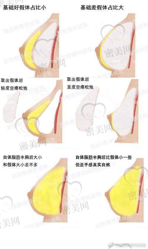 真人日记中的傲诺拉璀璨假体隆胸术成效