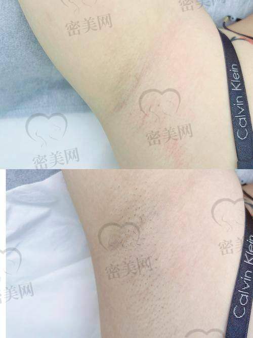杭州美莱医疗美容医院——林金德医生的脱毛魔法