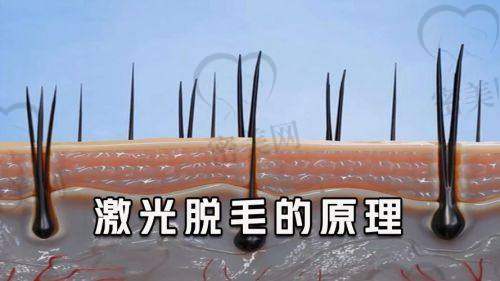 杭州格莱美医疗美容医院——章建林医生的脱毛美学