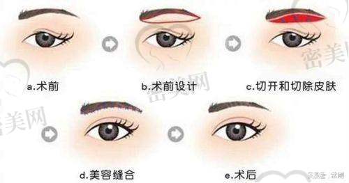 [医院名称1]提眉术特色