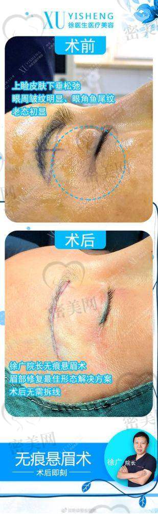 上海徳琳医疗美容提眉术揭秘