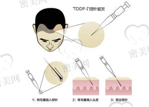 苏州名仕医院植发技术全方面且多样:满足不同需求