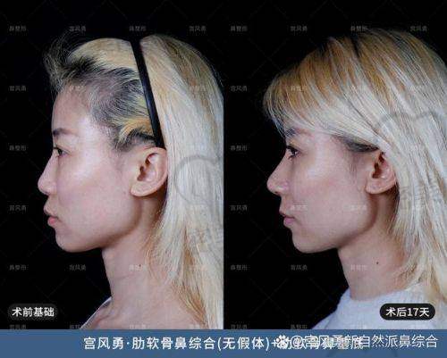 王旭明医生鼻整技术解析