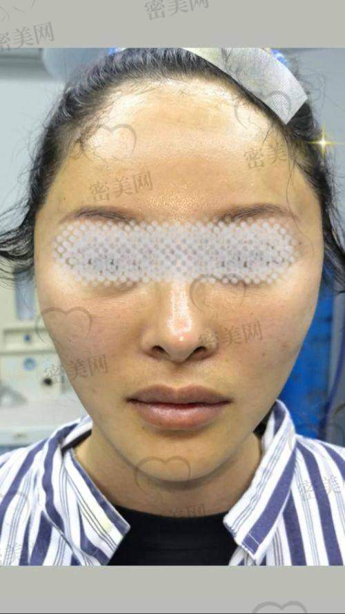 李喆筋膜提升修复期多久?术后体验曝光