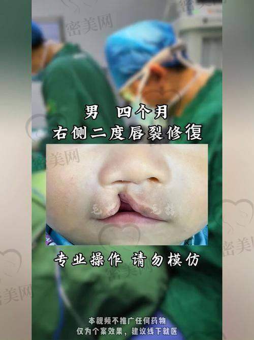 石家庄美联臣整形医院郭东超唇部二次修复:真人实例见证奇迹
