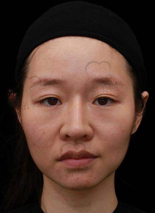 石家庄美联臣整形医院郭东超面部脂肪填充:真人实例,12800 元焕颜奇迹!