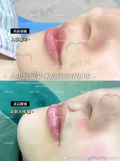 术前术后修养周期及注意点