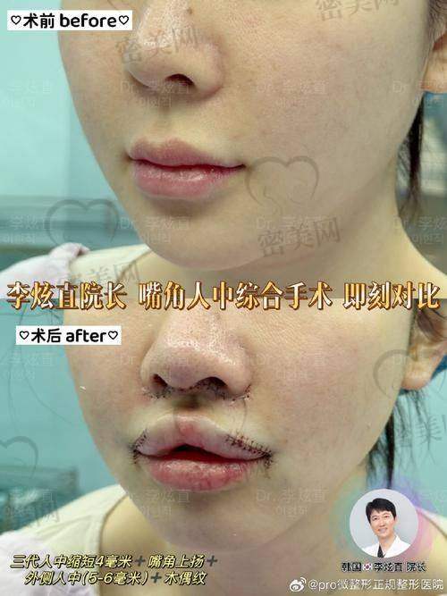 适合人群及术前评估标准